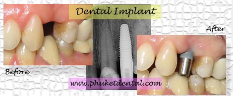 Dental Implants by Phuket Dentist at Phuket Dental Clinic in Phuket,Thailand